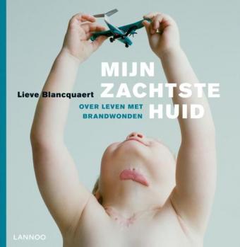 Cover van boek Mijn zachtste huid: over leven met brandwonden